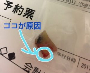 抜歯後の歯の画像