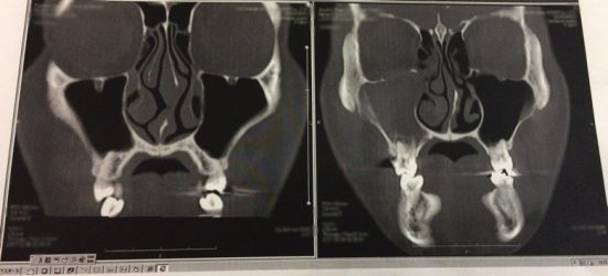 虫歯で副鼻腔炎CT画像