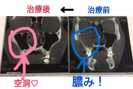 虫歯で副鼻腔炎抗生物質で治療CT画像